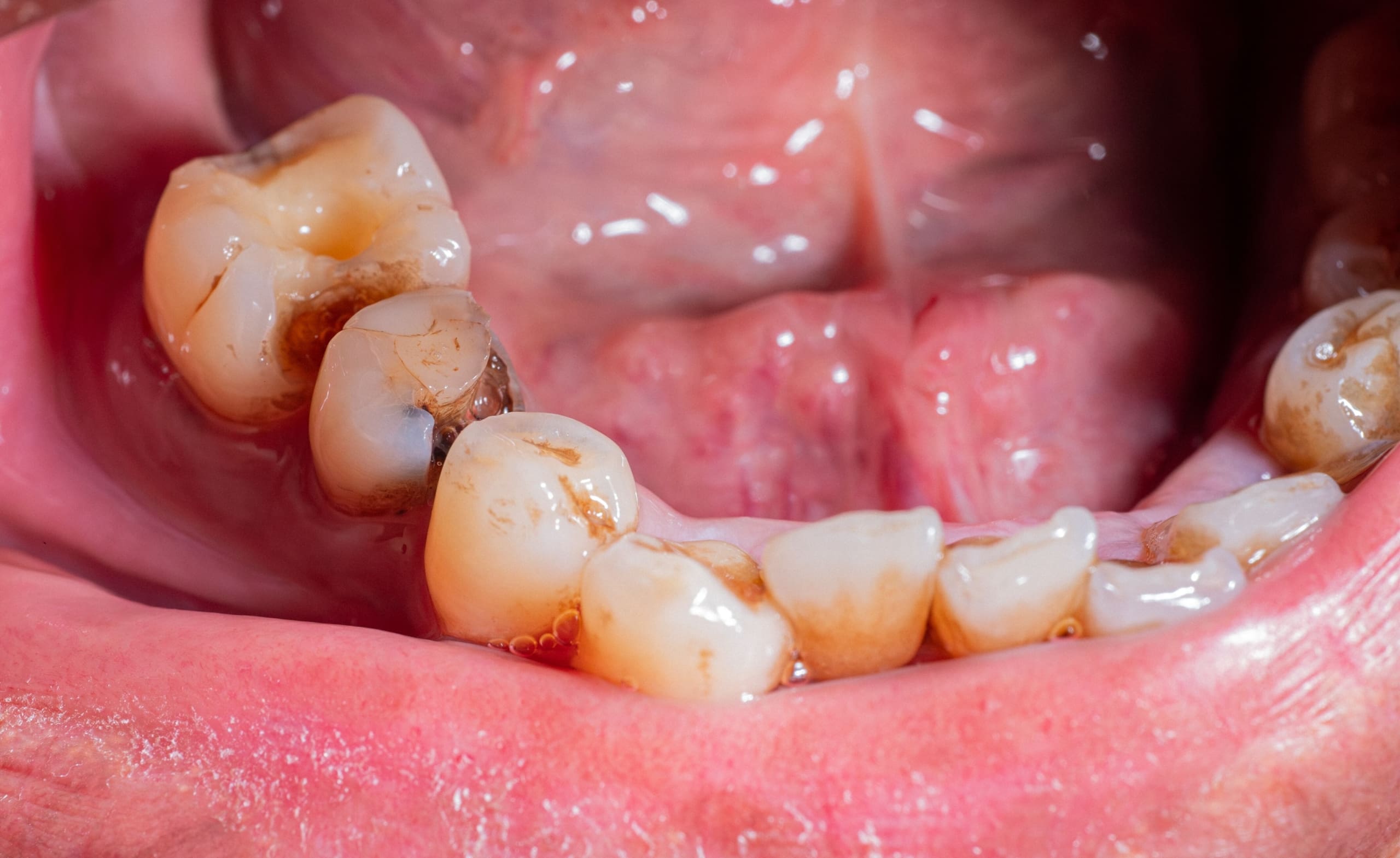Open mouth showing teeth with cavities and decay